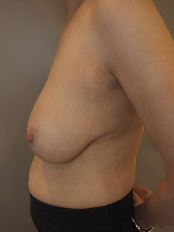 Breast Asymmetry Before & After Image