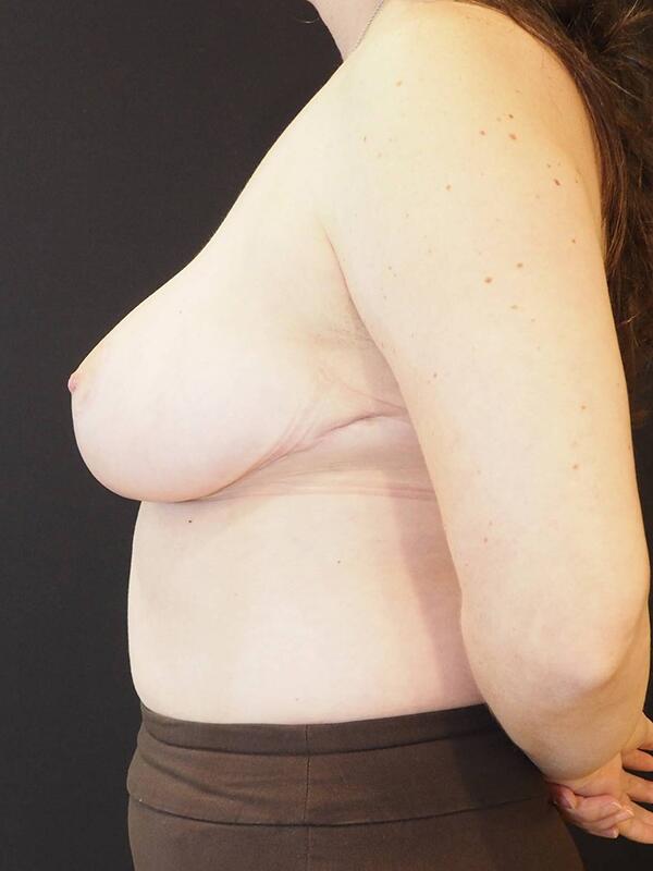 Breast Asymmetry Before & After Image