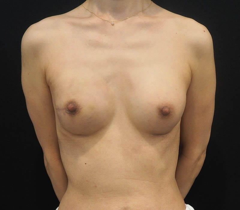 Breast Reconstruction Before & After Image
